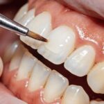 A dental brush, used in top practices of cosmetic dentistry, applies a coating or whitening agent to a person's upper front tooth.