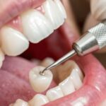 A dentist uses a dental drill on a patient's tooth during a restorative dentistry procedure, reflecting modern dentistry practices in 2026.
